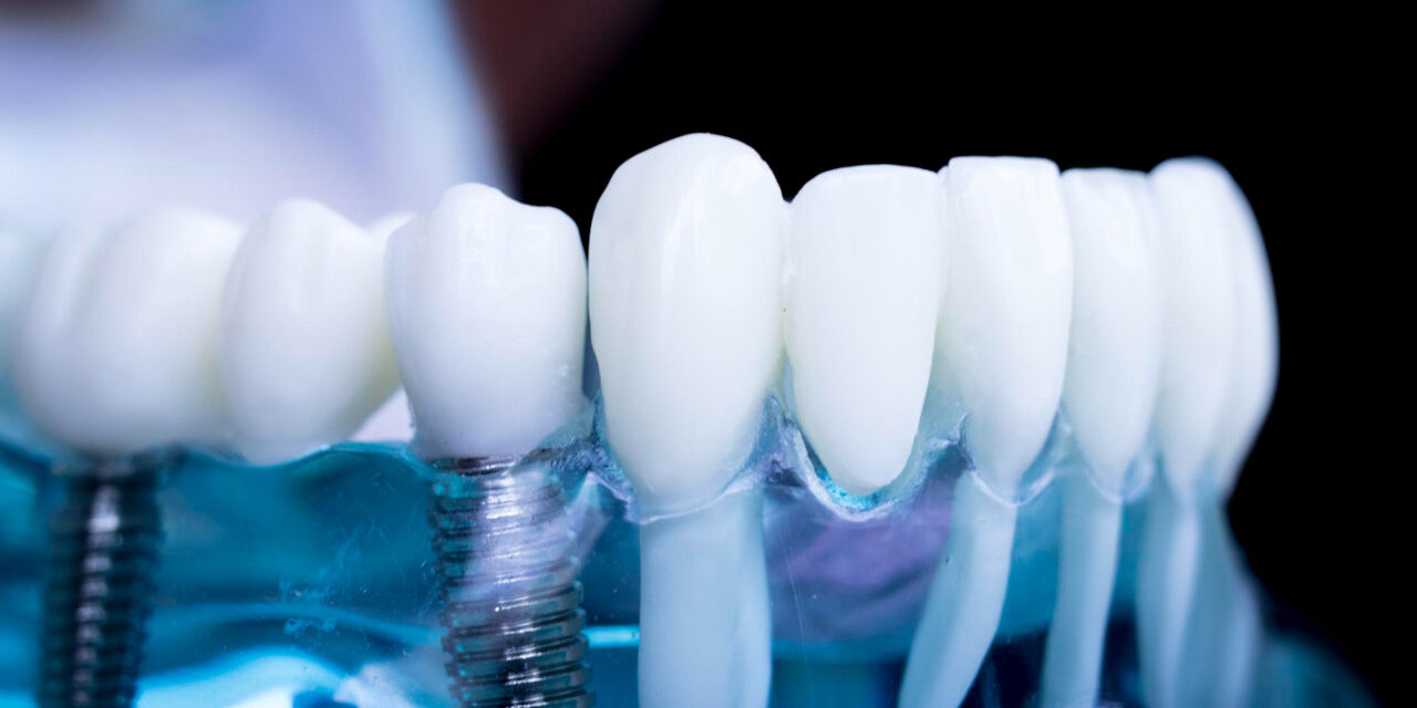 Wszystko, co warto wiedzieć o implantach zębów: Przebieg zabiegu, wskazania, przeciwwskazania i trwałość implantów