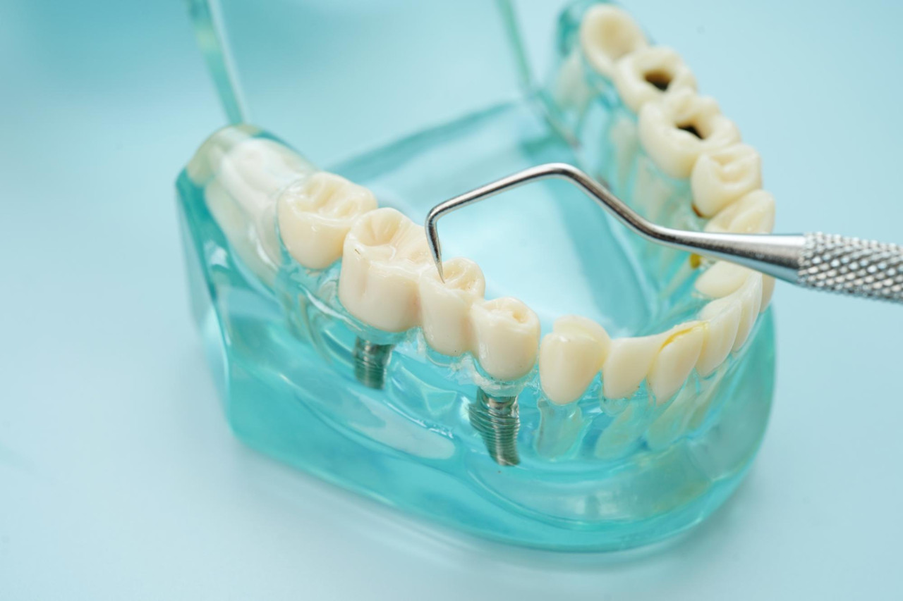 implanty zębów - model 